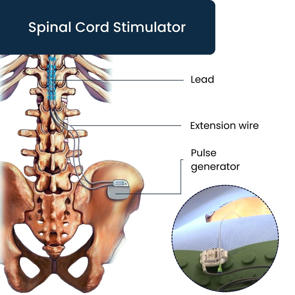 Spinal Cord Stimulator