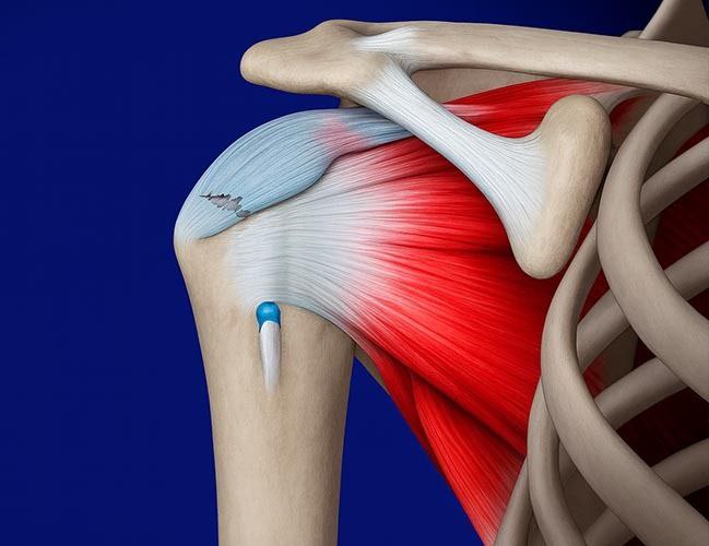 Rotator Cuff Injury