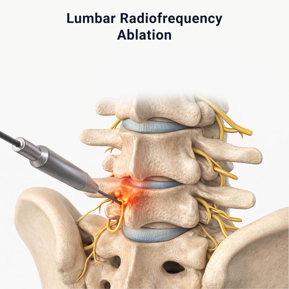Lumbar Radiofrequency Ablation