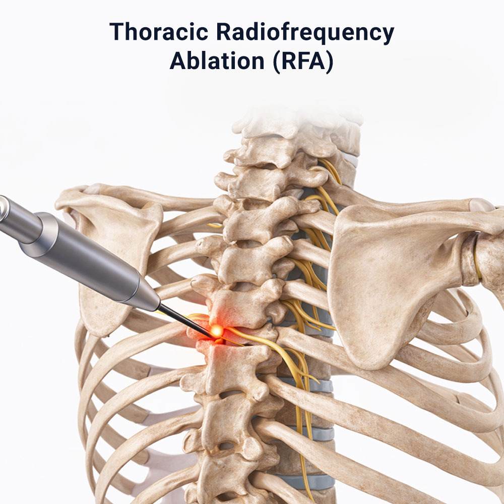 Thoracic Radiofrequency Ablation